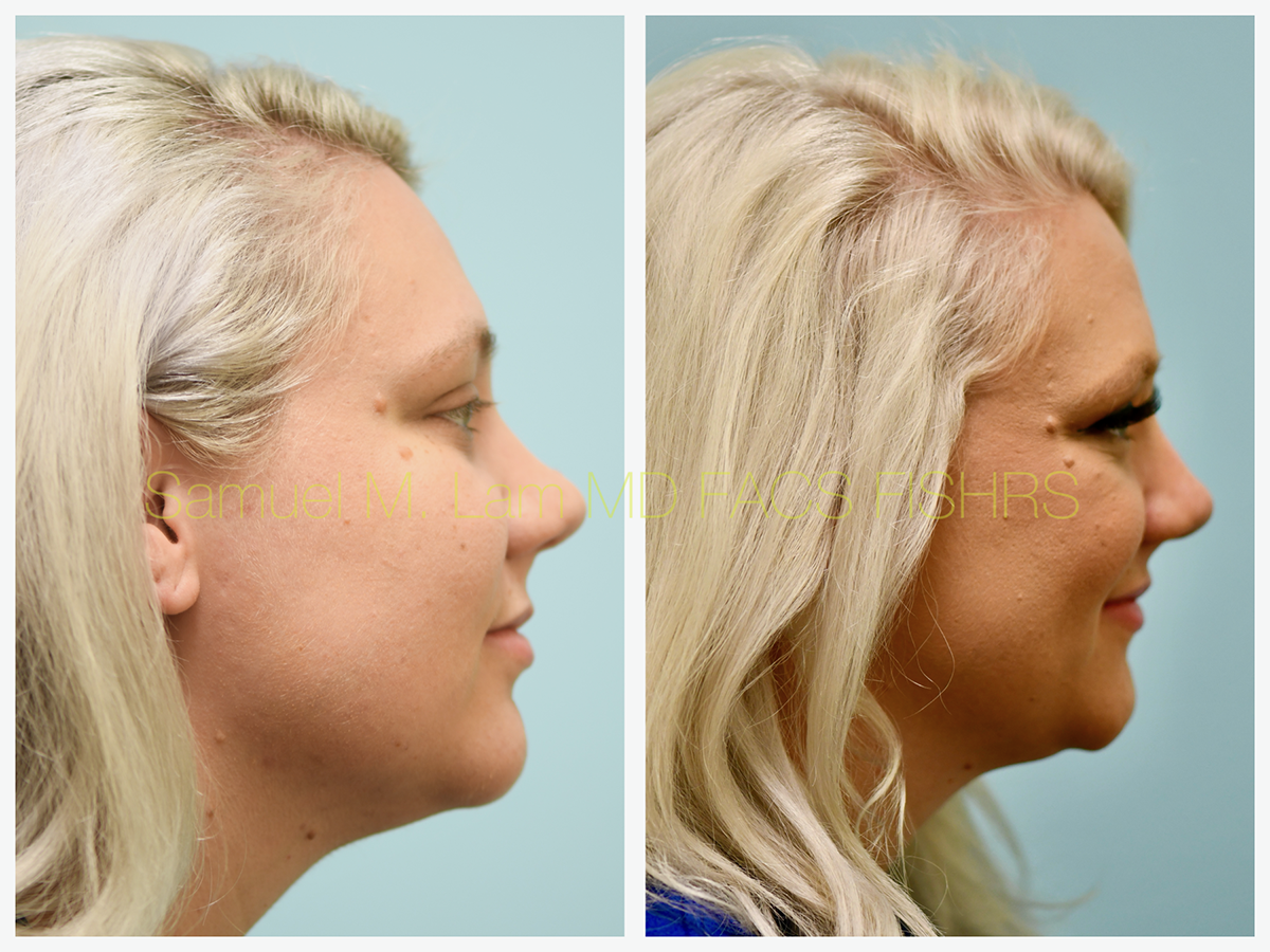 Mole Removal Before and After Photo by Dr. Lam in Plano, TX