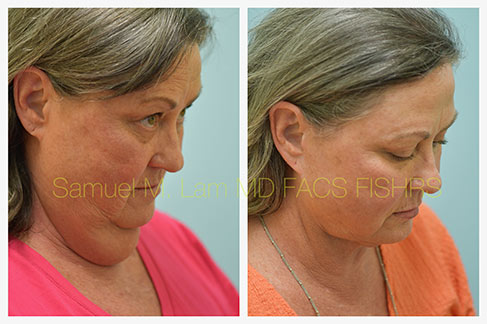 facelift before after dallas