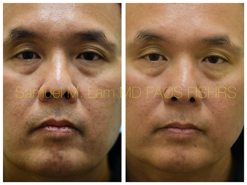 MesoBotox Before and After Photo by Dr. Lam in Plano TX
