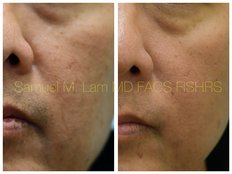 MesoBotox Before and After Photo by Dr. Lam in Plano TX