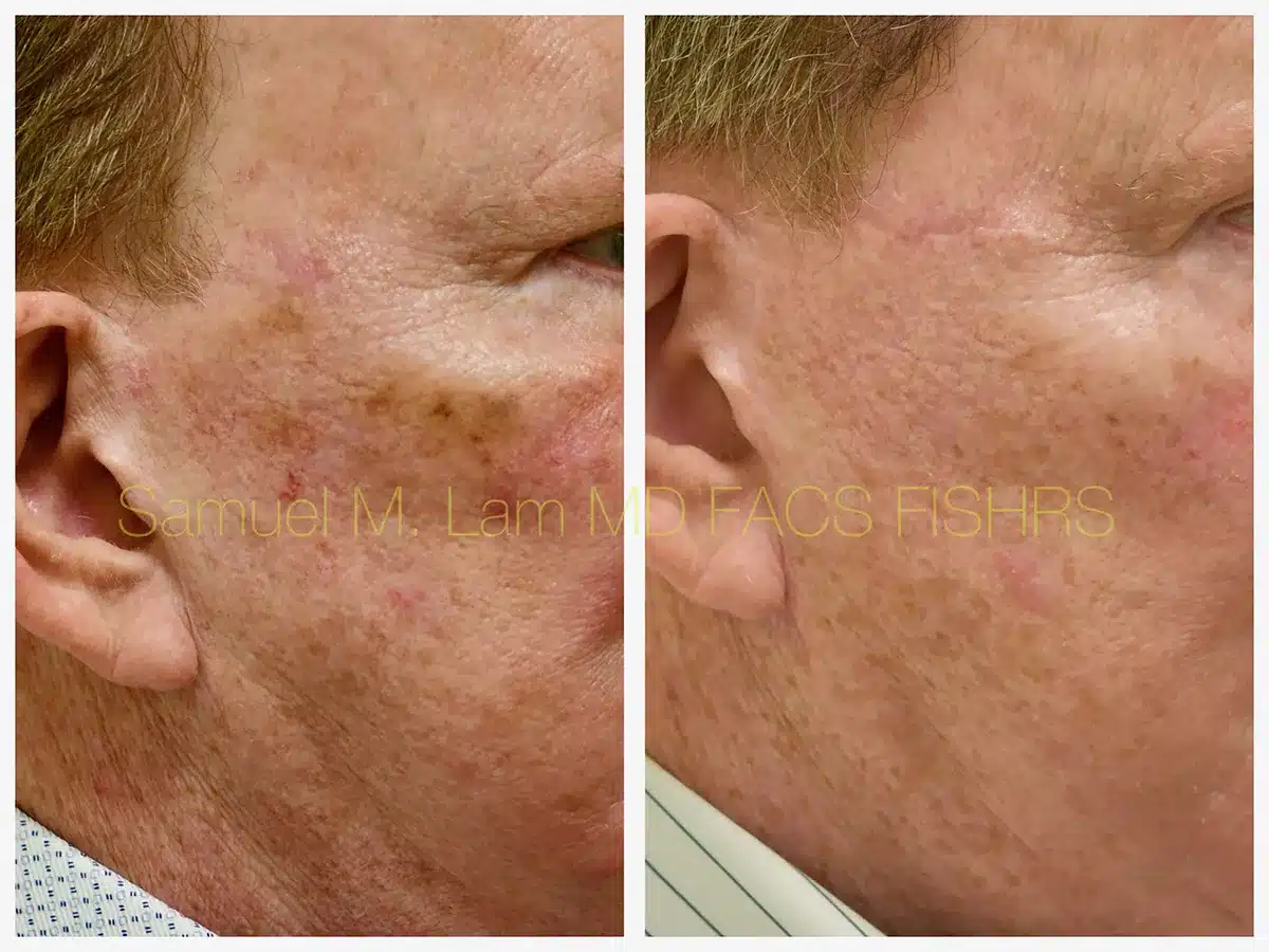 MesoTox Before and After Photo by Dr. Lam in Plano, TX MesoTox Before and After Photo by Dr. Lam in Plano, TX