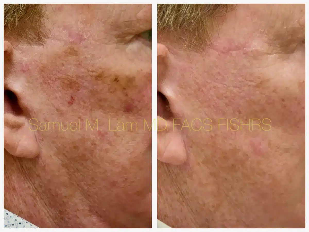 MesoTox Before and After Photo by Dr. Lam in Plano, TX MesoTox Before and After Photo by Dr. Lam in Plano, TX