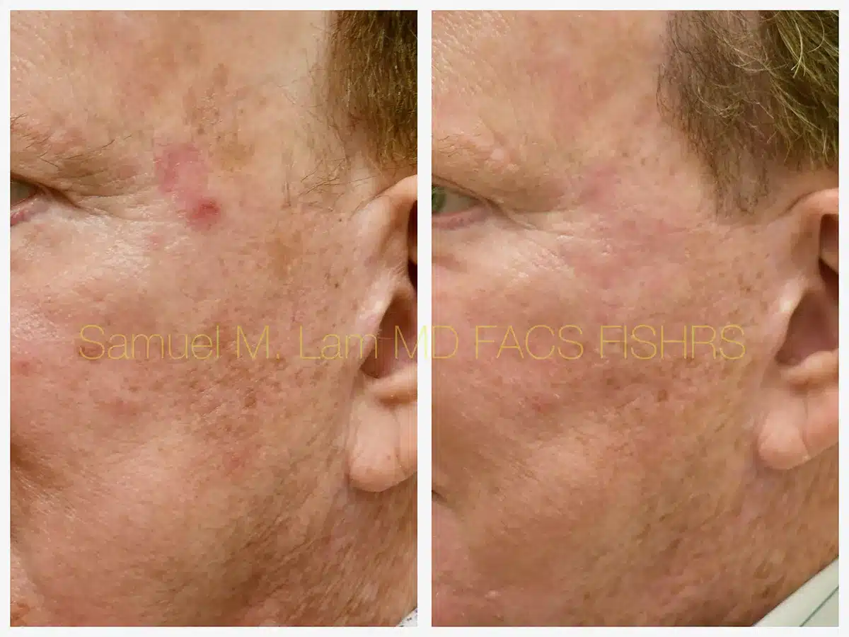 MesoTox Before and After Photo by Dr. Lam in Plano, TX MesoTox Before and After Photo by Dr. Lam in Plano, TX