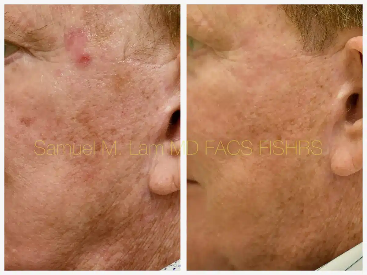 MesoTox Before and After Photo by Dr. Lam in Plano, TX MesoTox Before and After Photo by Dr. Lam in Plano, TX