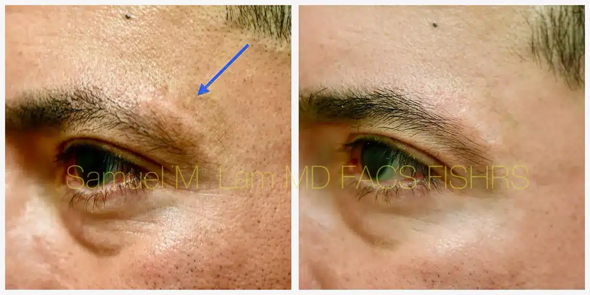 Scar Revision Before and After Photo by Dr. Lam in Plano TX