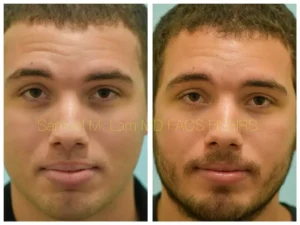 Lip Reduction Before and After Photo by Dr. Lam in Plano TX