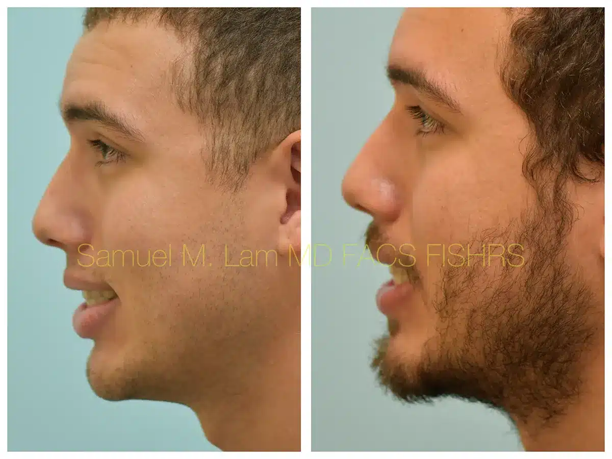 Lip Reduction Before and After Photo by Dr. Lam in Plano, TX Lip Reduction Before and After Photo by Dr. Lam in Plano, TX