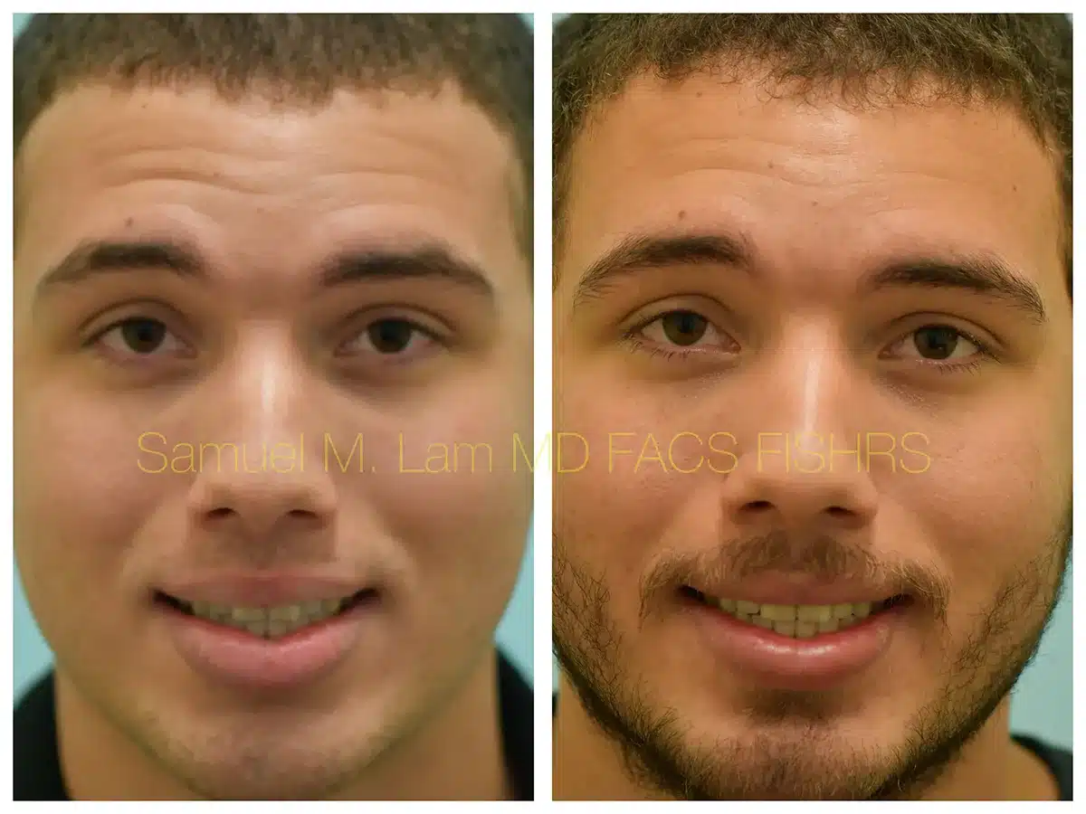 Lip Reduction Before and After Photo by Dr. Lam in Plano, TX Lip Reduction Before and After Photo by Dr. Lam in Plano, TX