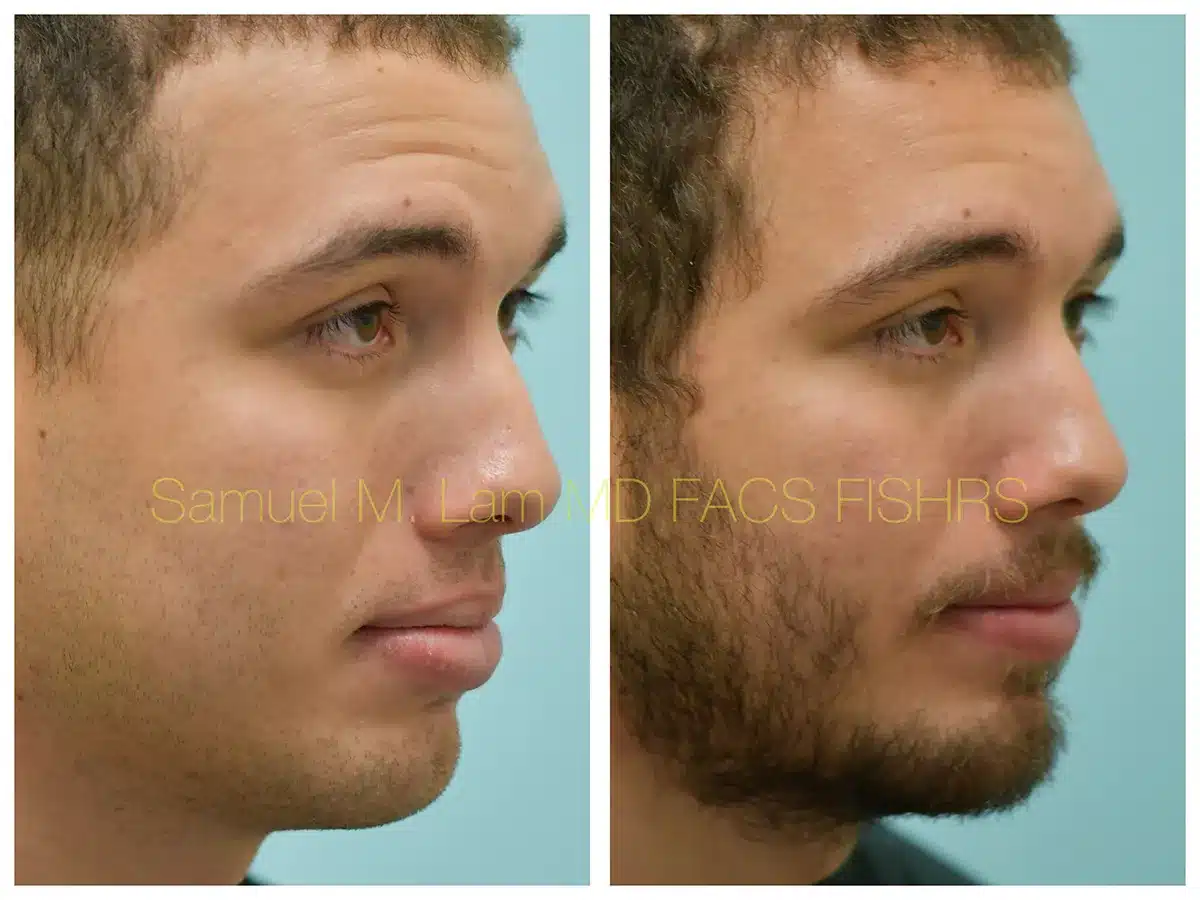 Lip Reduction Before and After Photo by Dr. Lam in Plano, TX Lip Reduction Before and After Photo by Dr. Lam in Plano, TX
