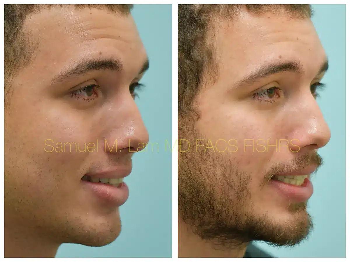 Lip Reduction Before and After Photo by Dr. Lam in Plano, TX Lip Reduction Before and After Photo by Dr. Lam in Plano, TX