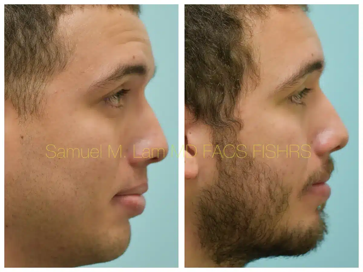 Lip Reduction Before and After Photo by Dr. Lam in Plano, TX Lip Reduction Before and After Photo by Dr. Lam in Plano, TX