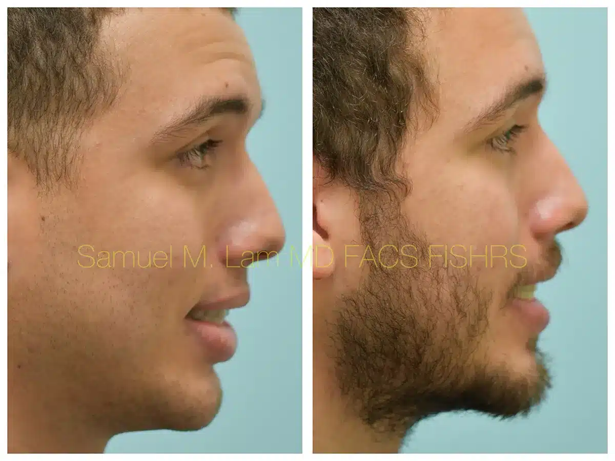 Lip Reduction Before and After Photo by Dr. Lam in Plano, TX Lip Reduction Before and After Photo by Dr. Lam in Plano, TX