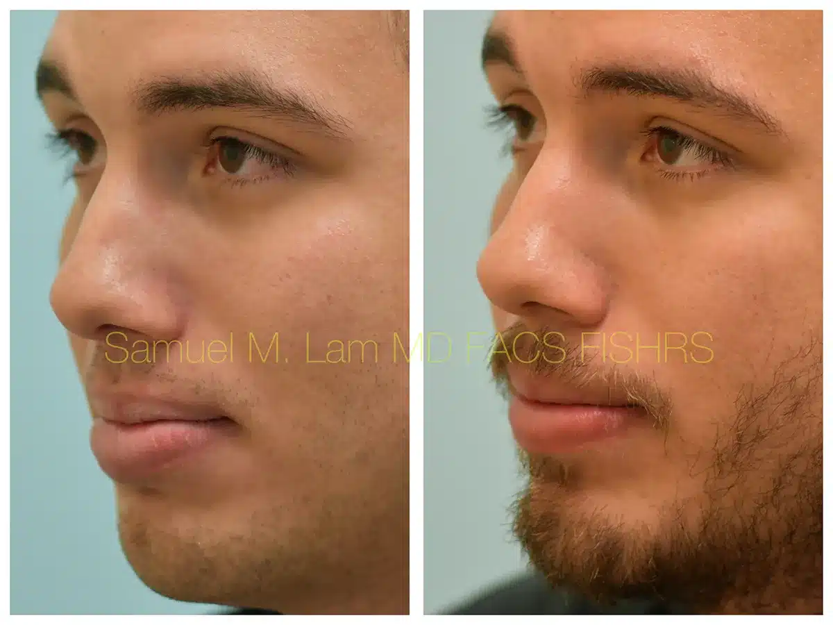 Lip Reduction Before and After Photo by Dr. Lam in Plano, TX Lip Reduction Before and After Photo by Dr. Lam in Plano, TX