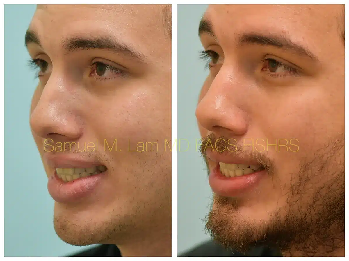 Lip Reduction Before and After Photo by Dr. Lam in Plano, TX Lip Reduction Before and After Photo by Dr. Lam in Plano, TX