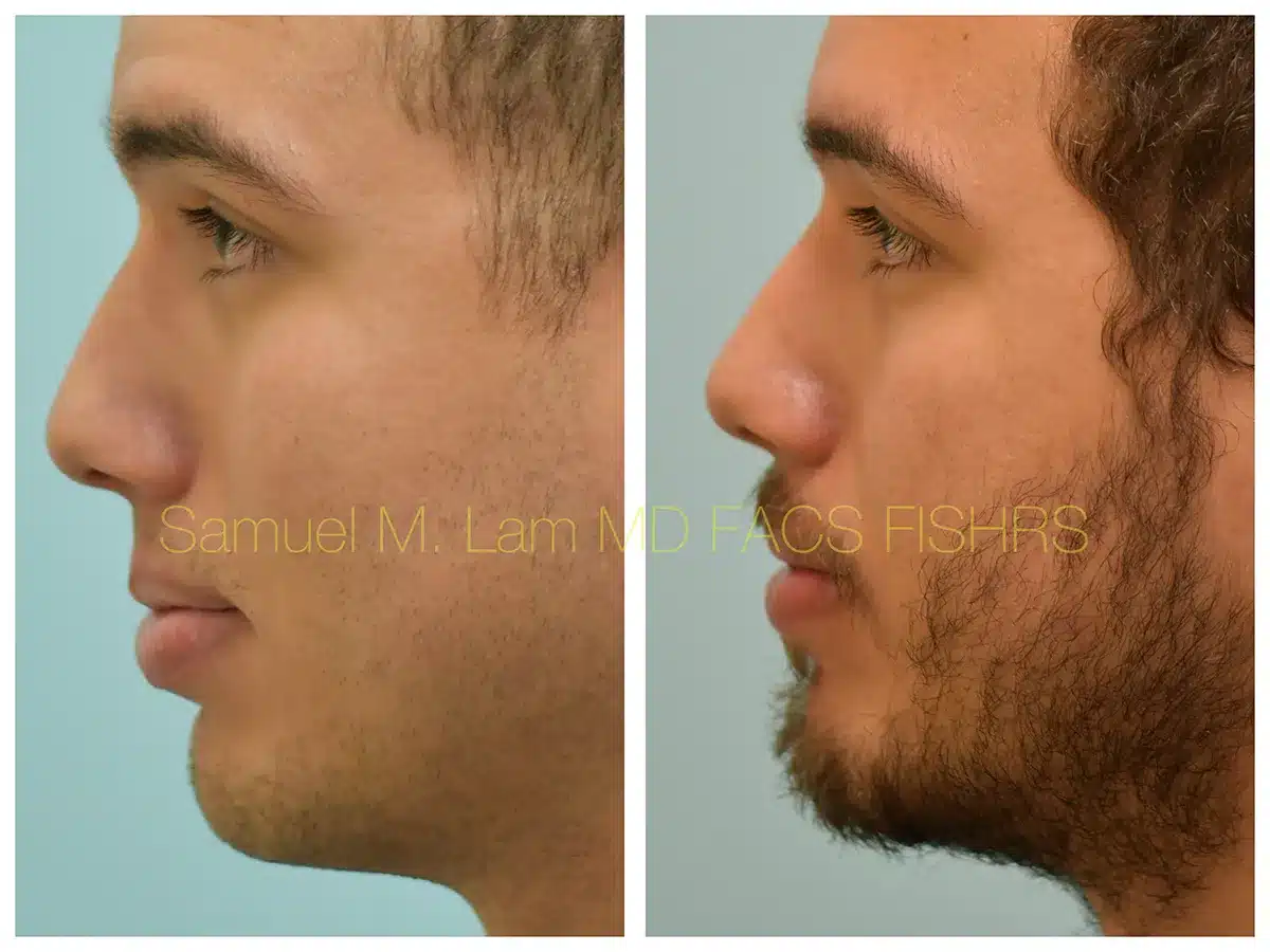 Lip Reduction Before and After Photo by Dr. Lam in Plano, TX Lip Reduction Before and After Photo by Dr. Lam in Plano, TX