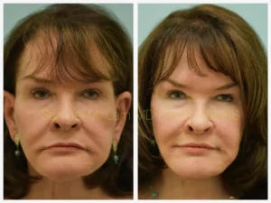 Lip lift Before and After Photo by Dr. Lam in Plano TX
