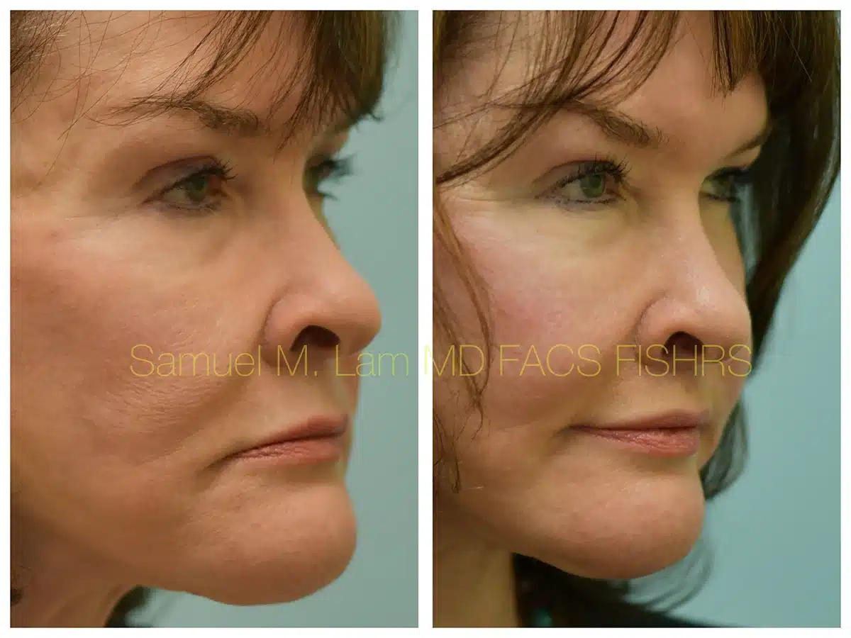 Lip lift Before and After Photo by Dr. Lam in Plano TX