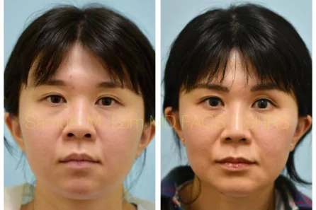 Front Rhinoplasty, Chin Augmentation, Facelift Before and After Photo by Dr. Lam