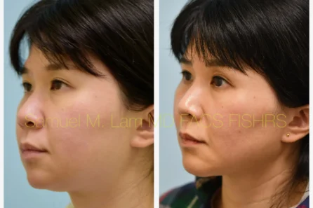 Left Oblique Rhinoplasty, Chin Augmentation, Facelift Before and After Photo by Dr. Lam