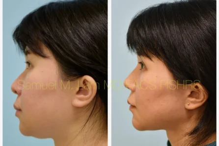 Left Profile Rhinoplasty, Chin Augmentation, Facelift Before and After Photo by Dr. Lam