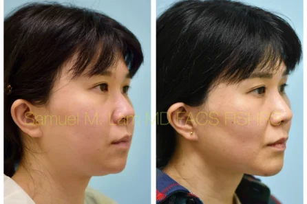 Right Oblique Rhinoplasty, Chin Augmentation, Facelift Before and After Photo by Dr. Lam