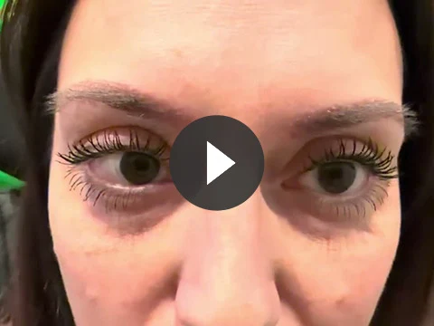 One week out from eyebrow transplant