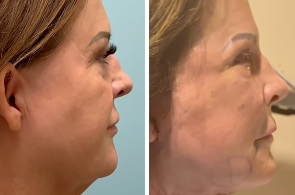 facelift results thumbnail