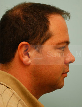 Chin Augmentation