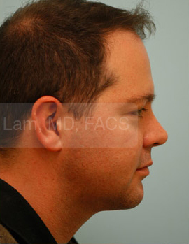 Chin Augmentation