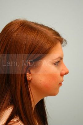 Chin Augmentation