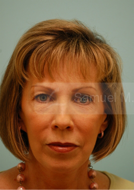Primary Facial Fat Transfer