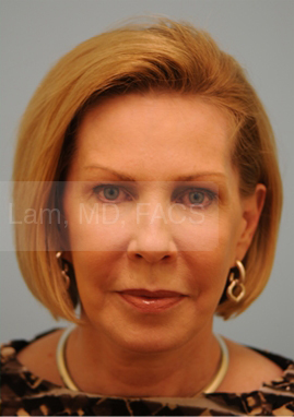 Primary Facial Fat Transfer