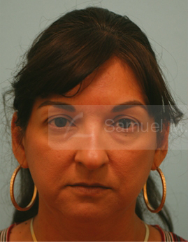 Primary Facial Fat Transfer