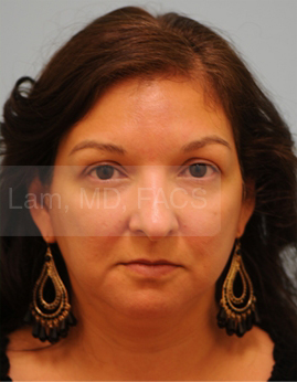 Primary Facial Fat Transfer