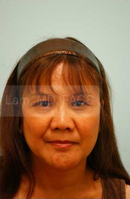 Primary Facial Fat Transfer