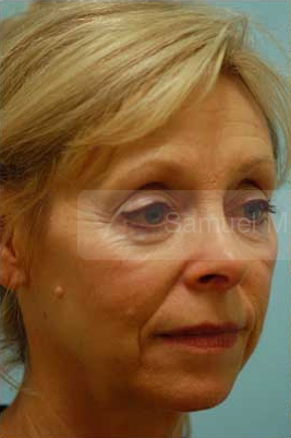 Primary Facial Fat Transfer
