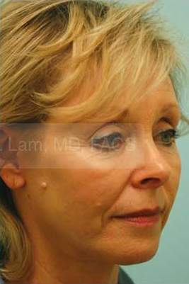Primary Facial Fat Transfer