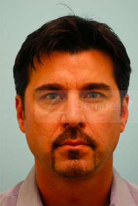 Primary Facial Fat Transfer