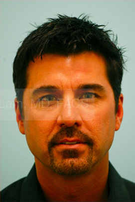 Primary Facial Fat Transfer