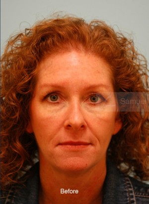 Primary Facial Fat Transfer