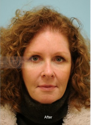 Primary Facial Fat Transfer