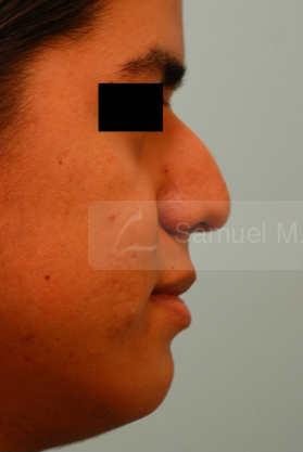 Rhinoplasty-Nose Job