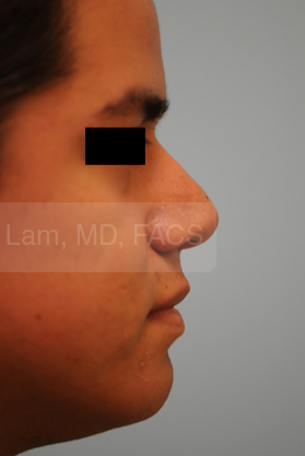 Rhinoplasty-Nose Job