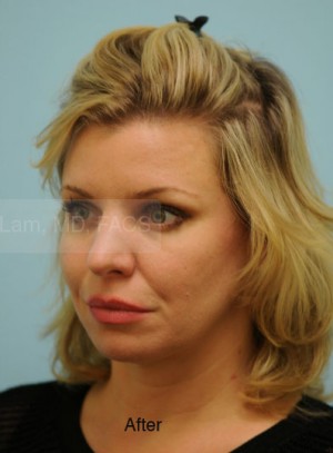 Rhinoplasty-Nose Job