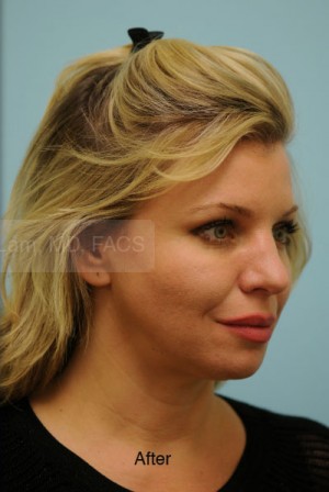 Rhinoplasty-Nose Job
