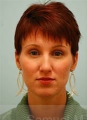 Revision/Corrective Rhinoplasty