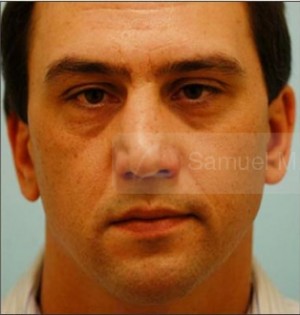 Revision/Corrective Rhinoplasty