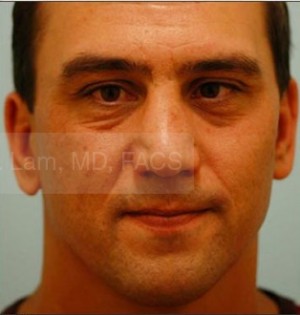 Revision/Corrective Rhinoplasty