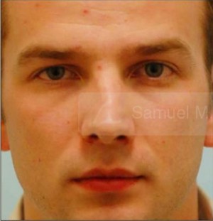 Revision/Corrective Rhinoplasty