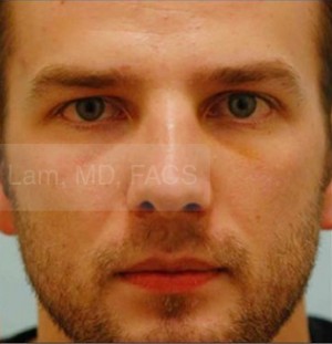 Revision/Corrective Rhinoplasty